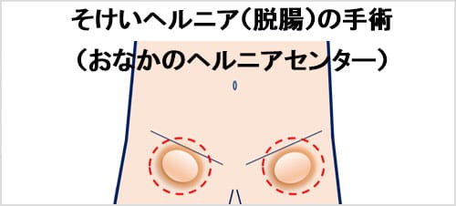 そけいヘルニア（脱腸）の手術（ヘルニア手術ユニット）