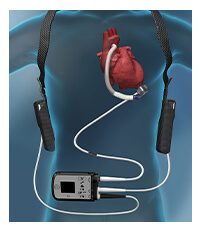 植込み型補助人工心臓システム