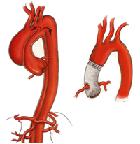 急性大動脈解離と手術の一例