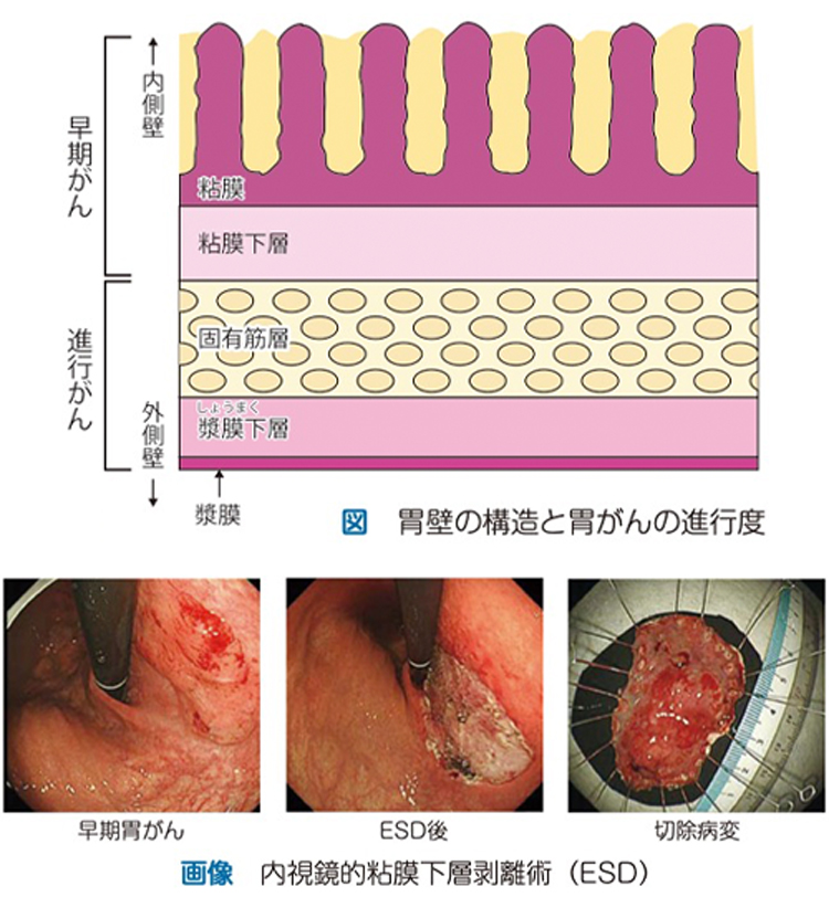 胃がん の 原因 ストレス