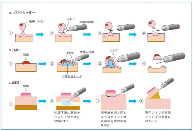 が 視 大腸 ん 鏡 手術 内