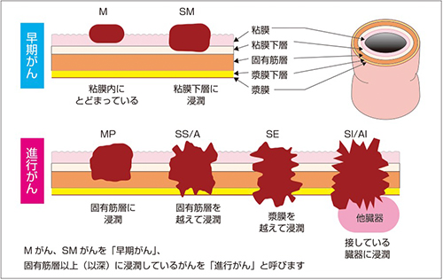 が 4 ステージ 大腸 ん 大腸がん ステージ４の現状と検診のススメ―