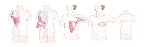 乳房再建術 近畿大学病院
