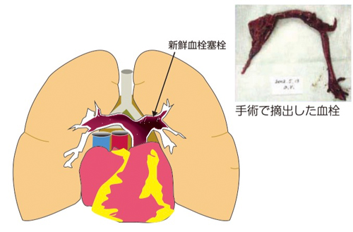 肺血栓塞栓症の治療 近畿大学病院