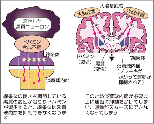 病 進行 パーキンソン