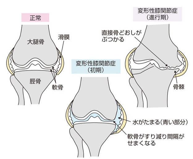 肥大型変形性関節症の種類