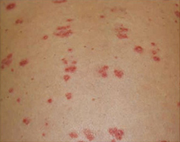 膝の裏の乾癬の写真