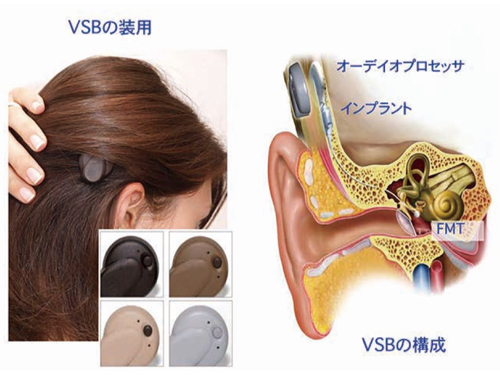 人工内耳