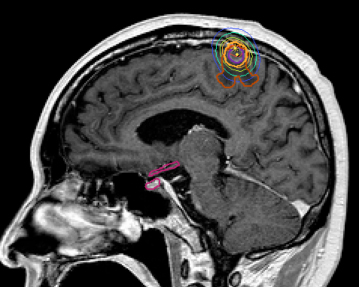 脳転移に対するピンポイント照射