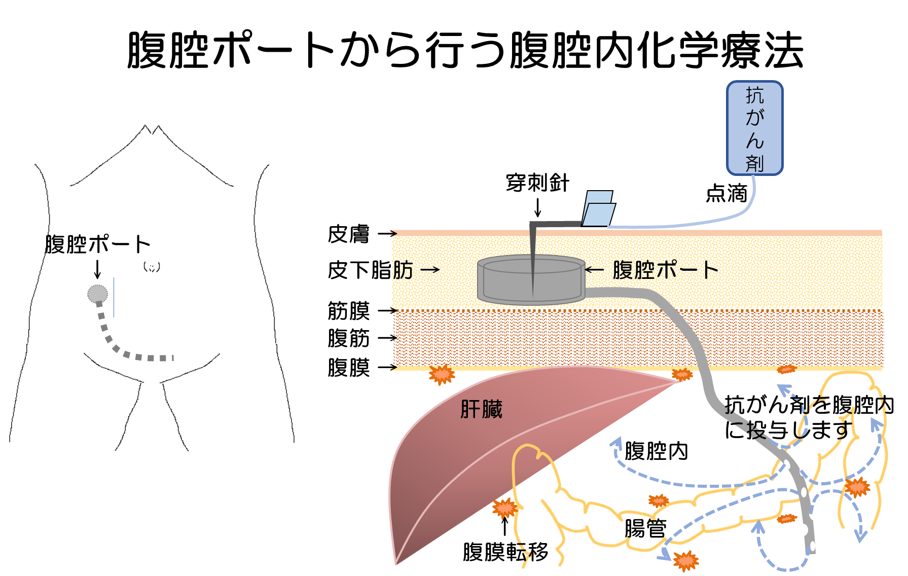 腹腔ポートから行う腹腔内化学療法.png