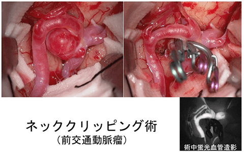 脳 動脈 瘤 手術