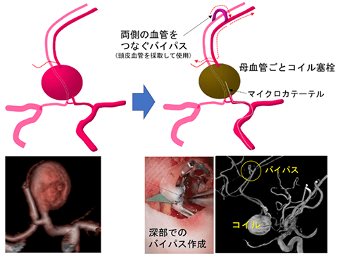 脳 動脈 瘤 手術