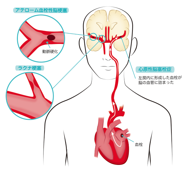 脳 梗塞 後遺症