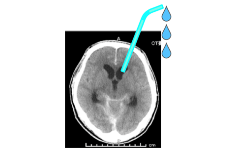 頭蓋 内圧 亢進