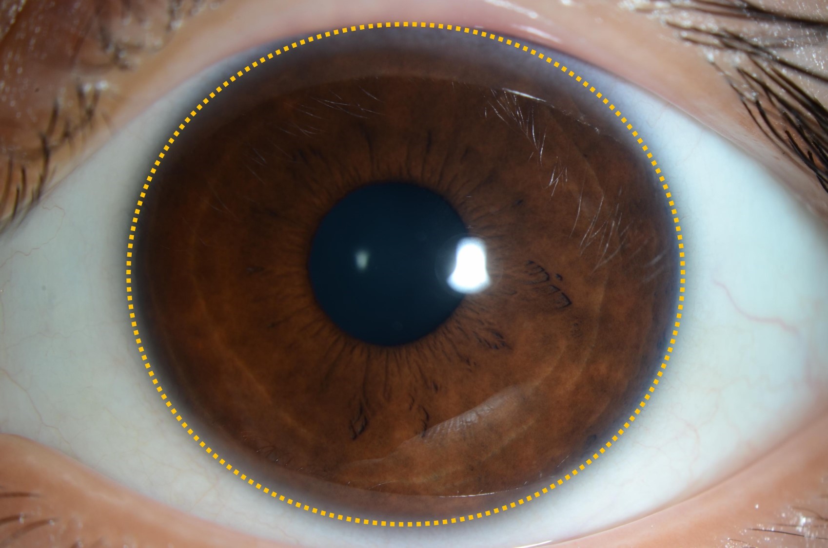 角膜剥離では何に注意すればよいですか?