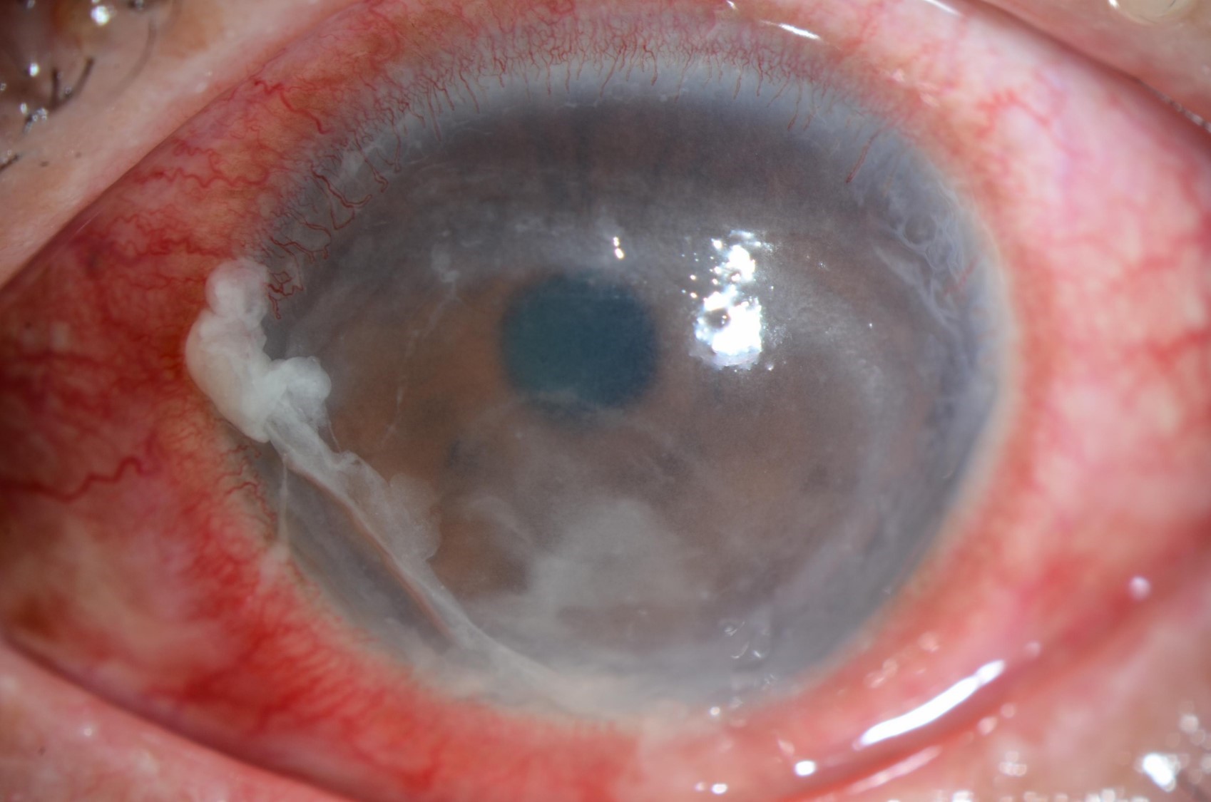 角膜擦伤和角膜异物（眼里有异物）-眼外伤 - 知乎