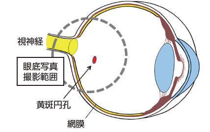 黄斑円孔の代表的な症状