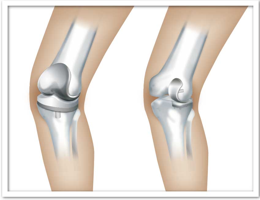 全置換術（TKA）と部分置換（UKA）