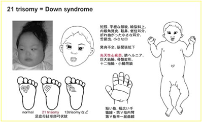 寿命 18 トリソミー